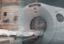 Artificial intelligence helping to improve early lung cancer detection