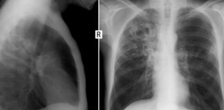 Is AI ready to interpret chest X-rays without human supervision?