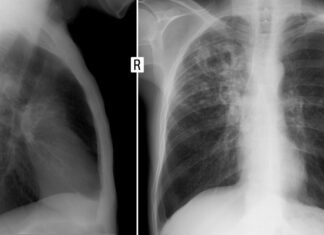 Is AI ready to interpret chest X-rays without human supervision?