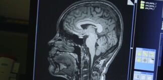 New UCLA AI tool targets Alzheimer’s cases often missed in early diagnosis