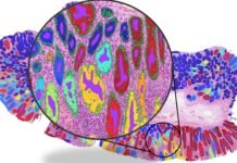 AI cancer tools may rely on ‘shortcut learning’ rather than genuine biological signals