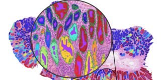 AI cancer tools may rely on ‘shortcut learning’ rather than genuine biological signals