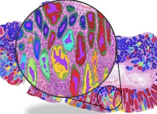 AI cancer tools may rely on ‘shortcut learning’ rather than genuine biological signals