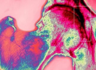 Bone is a wonder material. Scientists are defying physics to mimic it for longer-lasting hip replacements