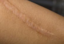 App-Controlled “Wound Zipper” Aids Bespoke Skin Healing