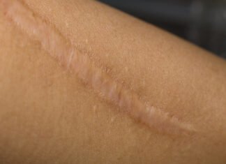 App-Controlled “Wound Zipper” Aids Bespoke Skin Healing